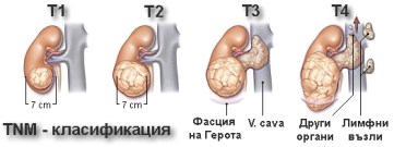 Tumor-bubrek-stadii